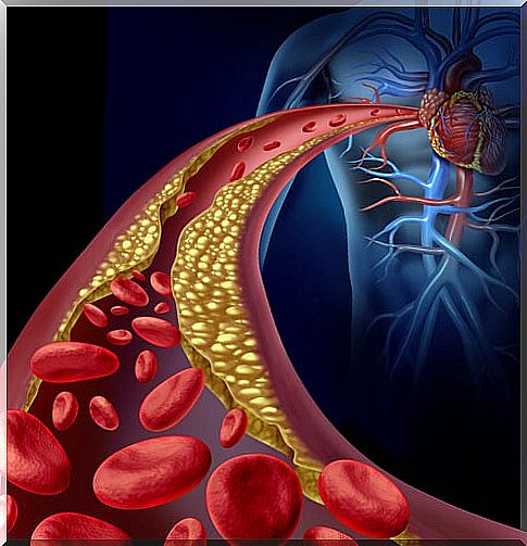 Artery with atherosclerosis