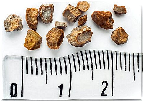 Kidney stones