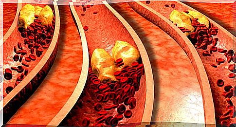 Plaques of atheroma (atherosclerosis)