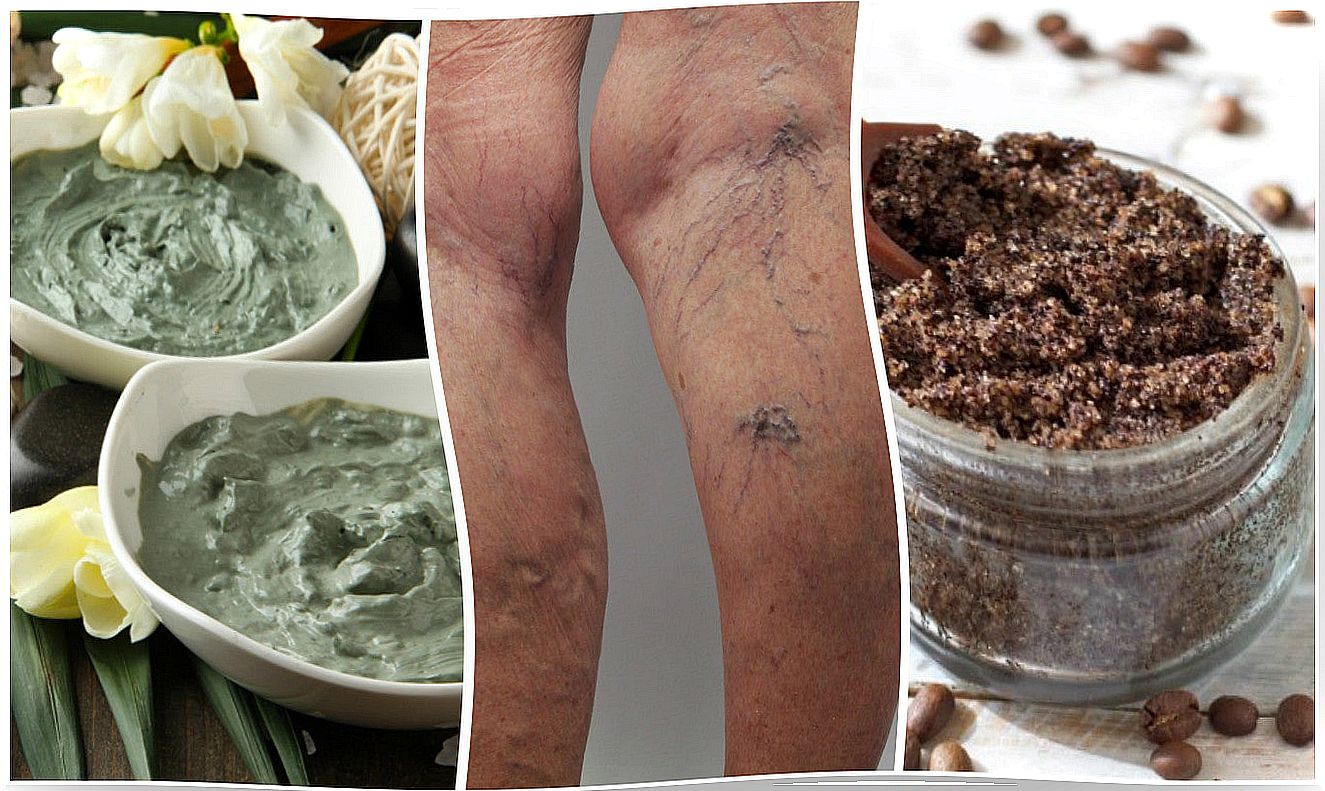 Can you remove varicose veins naturally?