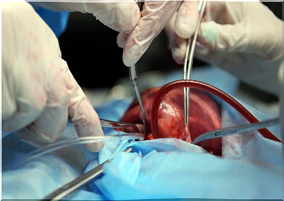 Coronary Bypass Procedure