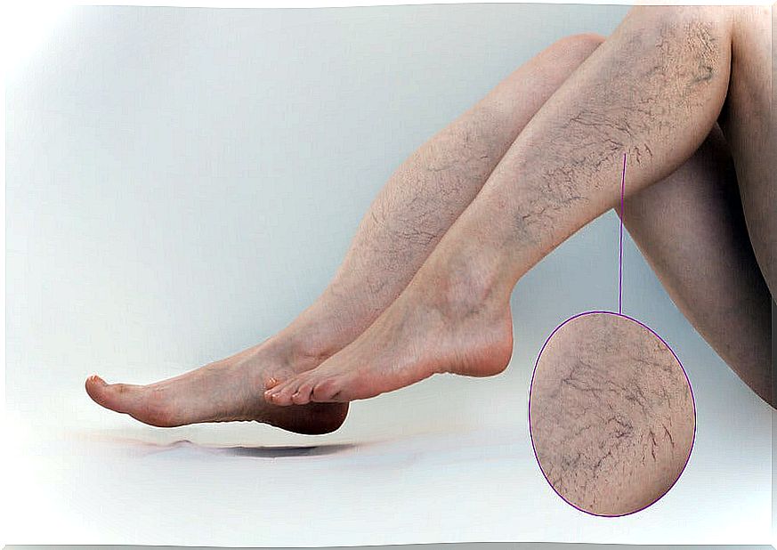 Exercises for varicose veins