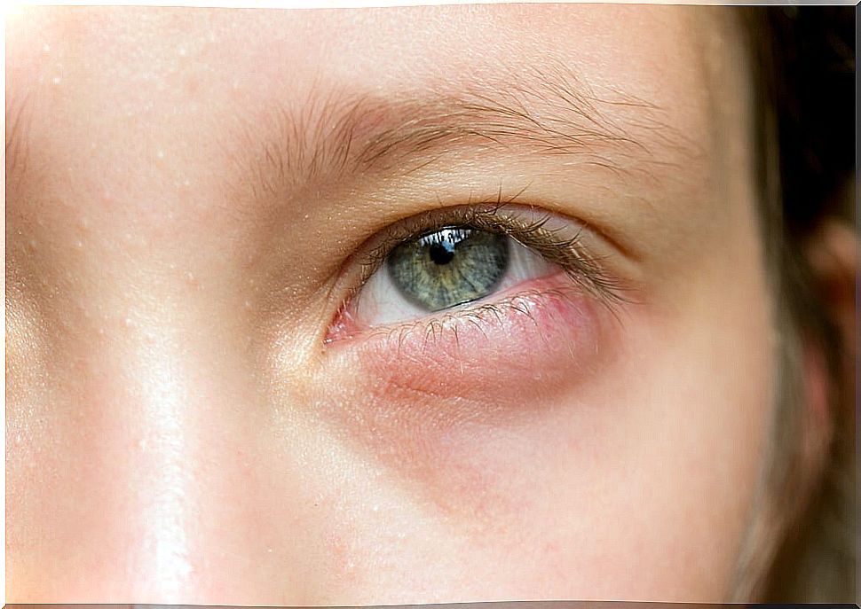 Did your eyes wake up puffy?  5 quick remedies to alleviate them