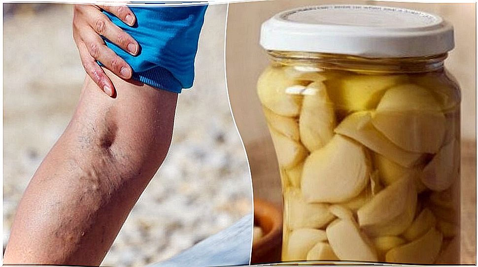 Garlic and orange home remedy to treat varicose veins