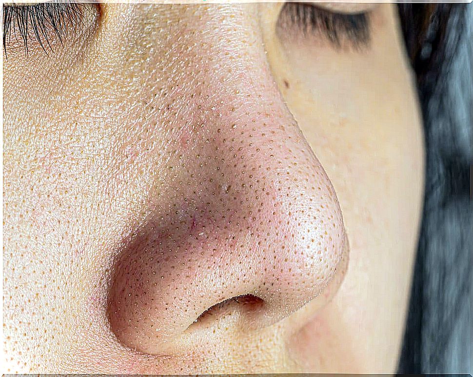 Facial skin with black dots.