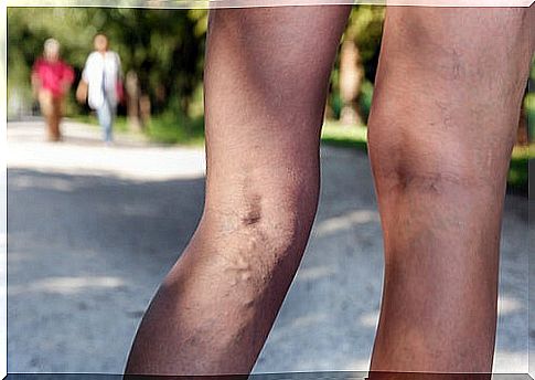 Legs with varicose veins