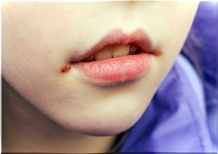 Child with impetigo