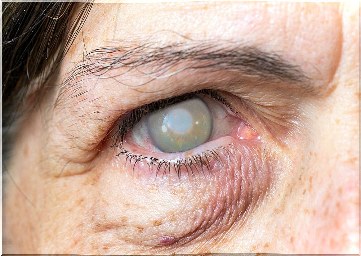 Cataracts that cause blindness.