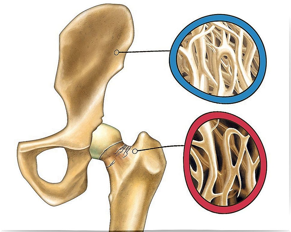 Osteoporosis