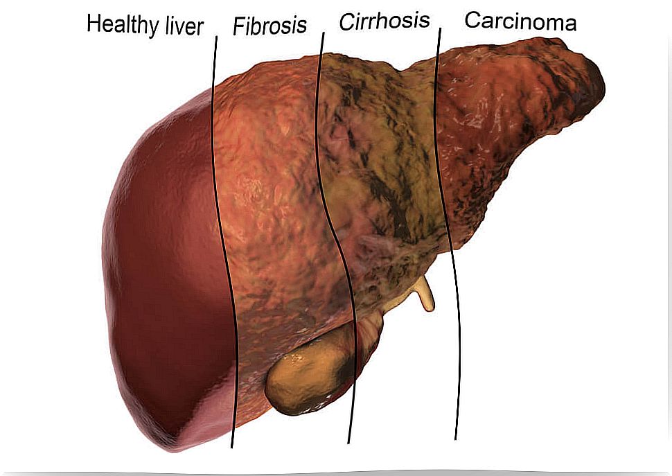 Different stages of liver health.  Importance of liver metabolism.