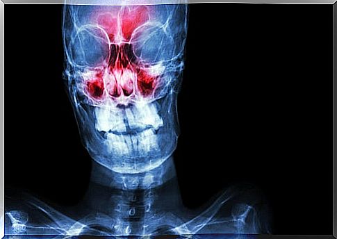 Image showing inflammation and infection in a sinus infection