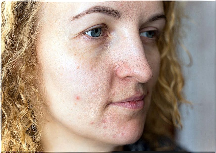 How to prevent melasma