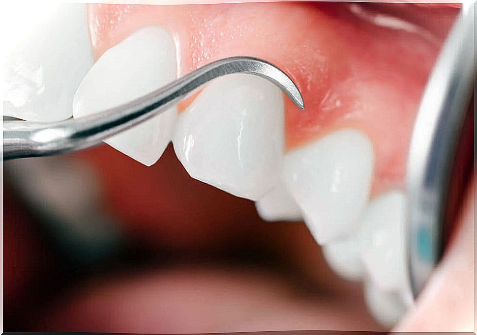 diagnosis of periodontitis