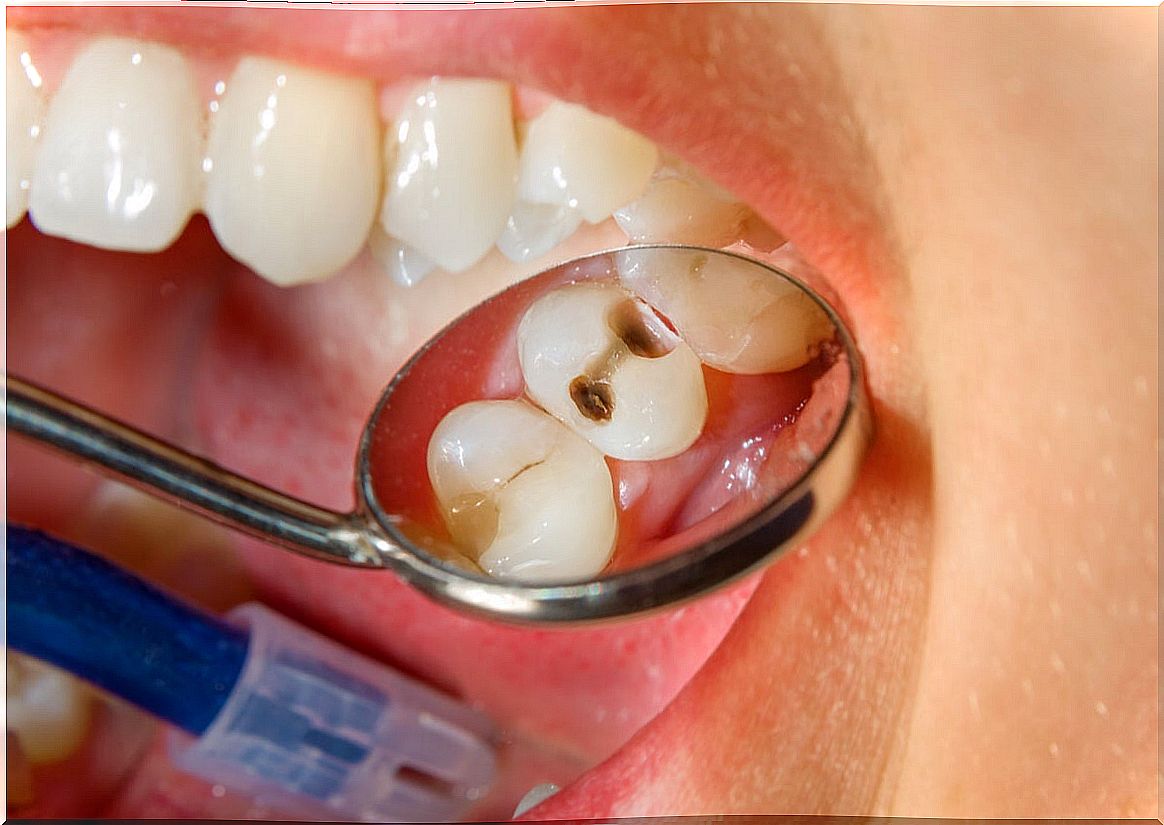 Tooth decay that is treated with propolis.