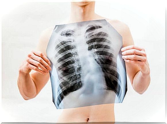 lungs affected by coronavirus