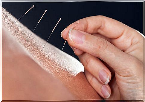 Acupuncture, one of the ancient healing techniques