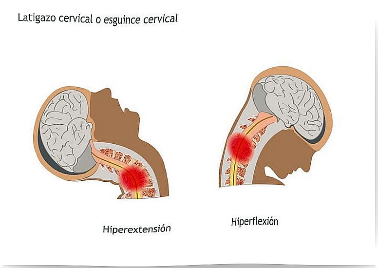 whiplash: symptoms